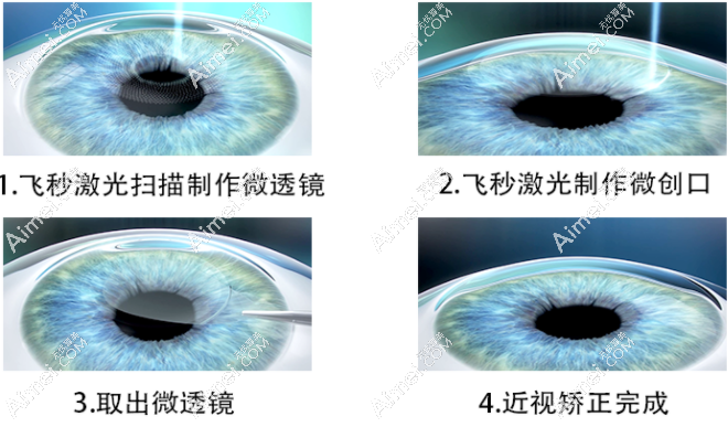 广州常春藤眼科做全飞秒近视眼技术好 广州常春藤眼科做全飞秒近视眼技术好