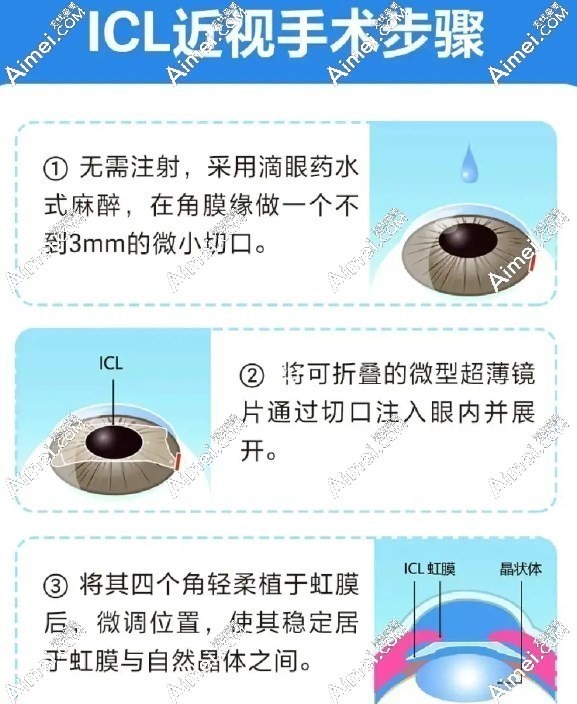 成都普瑞眼科医院艾碧君做icl手术步骤图解 成都普瑞眼科医院艾碧君做icl手术步骤图解