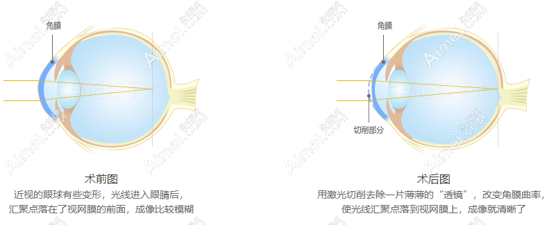 福州黑马眼科医院价目表:近视眼手术价格14850,老花眼19300起