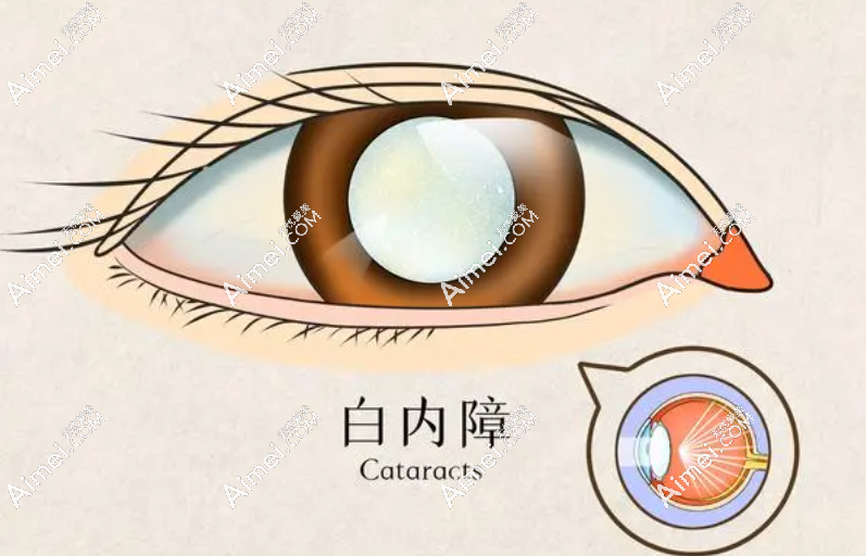 昆明做白内障手术哪家医院好?前3昆明眼科-华厦-普瑞技术好
