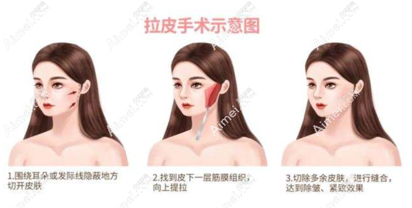 重庆华美整形医院小切口拉皮怎么样 重庆华美整形医院小切口拉皮怎么样