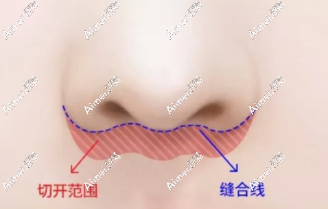 国内人中缩短术这10位医生做的好:余文林-马群-卢九宁技术赞