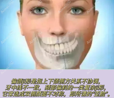 轻度偏颌正畸改变脸型大爱@美网 轻度偏颌正畸改变脸型大爱@美网