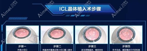 icl v4c晶体植入手术步骤 icl v4c晶体植入手术步骤