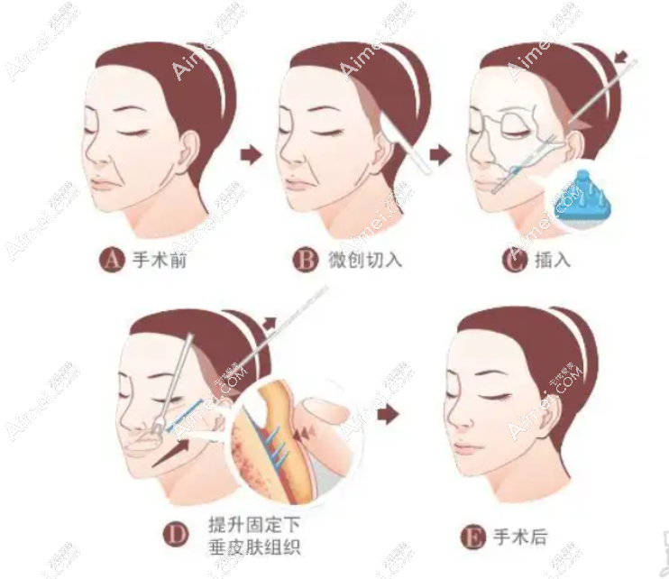 上海美莱小拉皮手术过程 上海美莱小拉皮手术过程