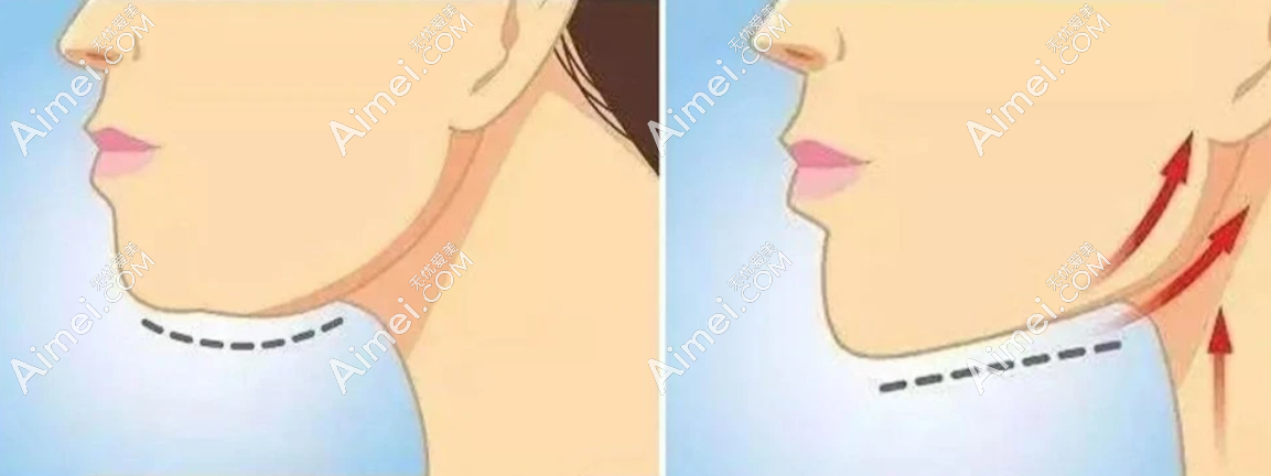脖子拉皮手术前后对比照片 脖子拉皮手术前后对比照片