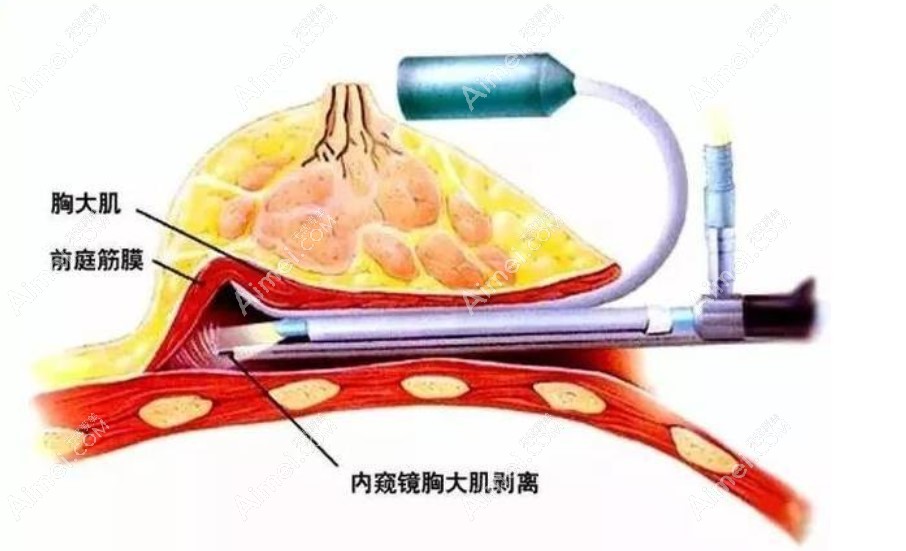 薛瑞做胸做得好很有名,揭晓薛瑞医生做的胸几天恢复好