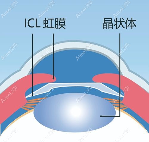 icl v4c晶体优缺点说明 icl v4c晶体优缺点说明
