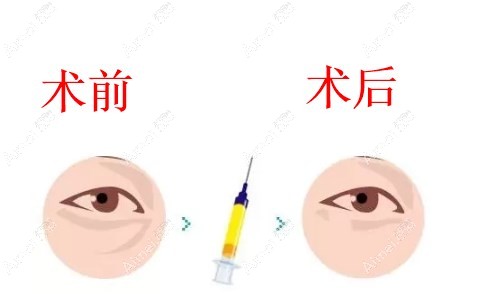 打完弗缦胶原即刻就有成效 打完弗缦胶原即刻就有成效