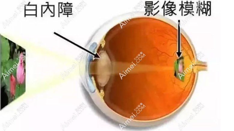白内障晶体脱位能做手术吗难度大吗?担心偏移不处理有危害