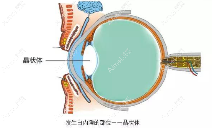白内障晶体脱位能做手术吗难度大吗爱#美网 白内障晶体脱位能做手术吗难度大吗爱#美网