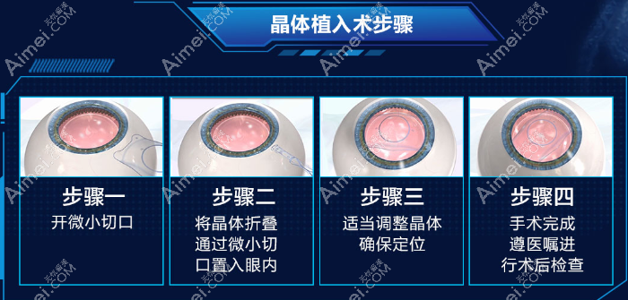 成都普瑞眼科医院艾碧君医生做icl晶体植入近视手术怎么样