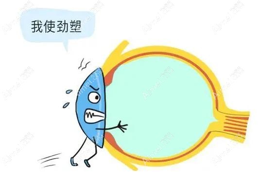 散光可以选择环曲片 散光可以选择环曲片