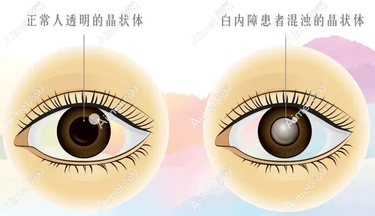 白内障老人手术是免费还是自费好 白内障老人手术是免费还是自费好