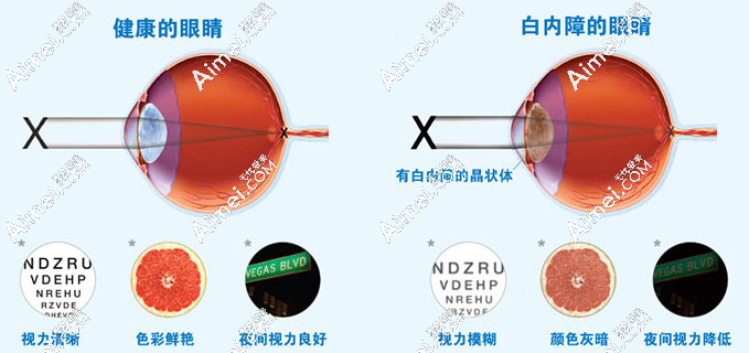 白内障手术是免费还是自费的好 白内障手术是免费还是自费的好