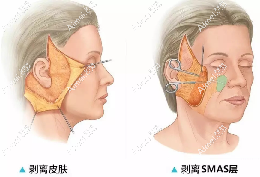 王志军医生smas面部提升怎么样 王志军医生smas面部提升怎么样
