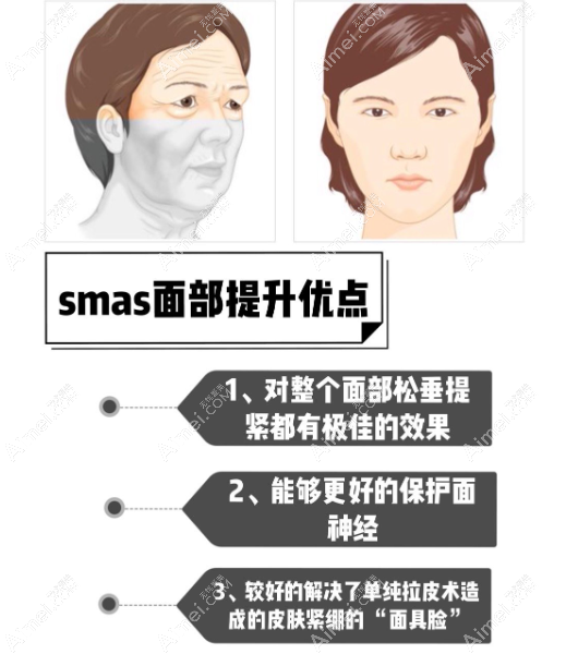 王志军sams面部提升怎么样 王志军sams面部提升怎么样