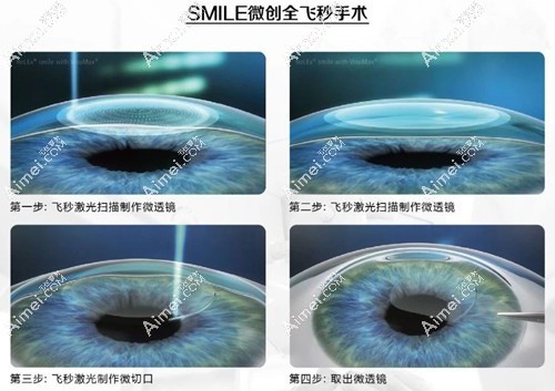 全飞秒手术过程www.aimei.com 全飞秒手术过程www.aimei.com
