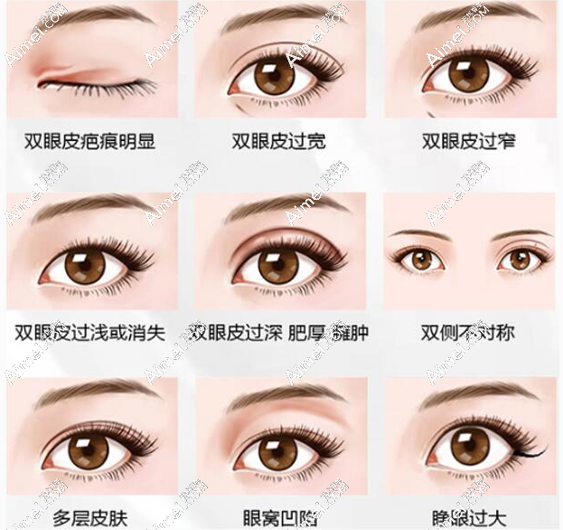 大连刘志刚双眼皮修复实例 大连刘志刚双眼皮修复实例