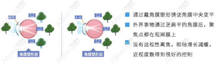 麦迪格眼科配角膜塑形镜真的好 麦迪格眼科配角膜塑形镜真的好