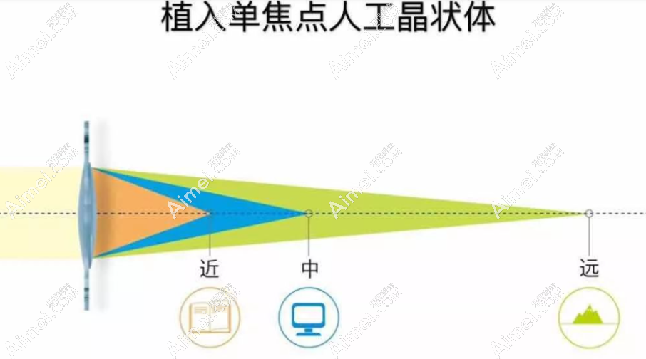爱尔康sn6cws单焦点非球面人工晶体怎么样 爱尔康sn6cws单焦点非球面人工晶体怎么样