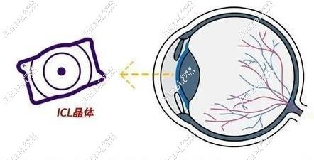 郑州做晶体植入手术好的眼科医院排名 郑州做晶体植入手术好的眼科医院排名