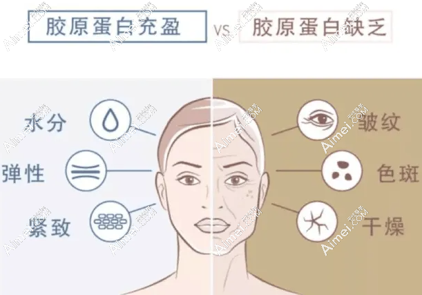 弗缦胶原蛋白是国产1+3型胶原的功效和作用 弗缦胶原蛋白是国产1+3型胶原的功效和作用