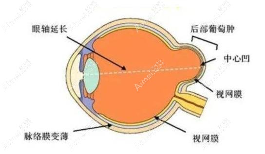段安丽后巩膜加固术成效