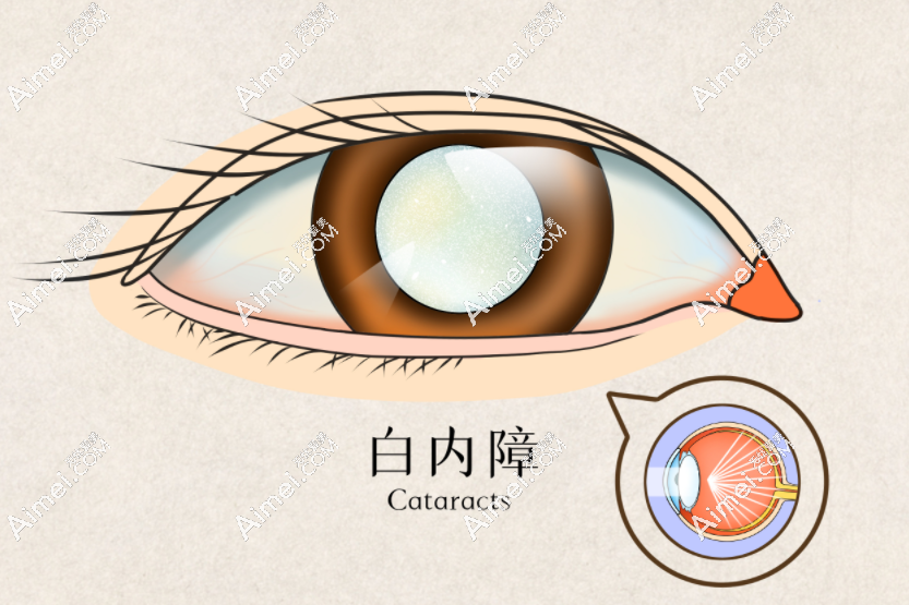 南昌白内障手术优惠政策:手术报销比例50%,还可申请免费手术