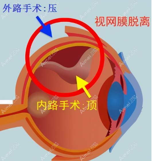 视网膜脱落手术方法有外路和内路两种 视网膜脱落手术方法有外路和内路两种