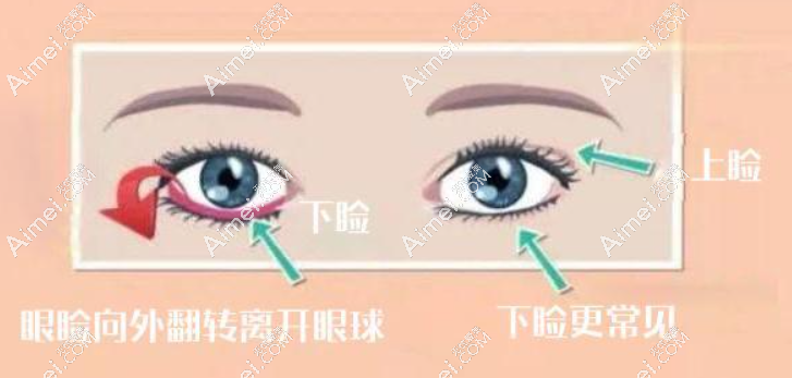 重度下眼睑退缩修复用什么方法好 重度下眼睑退缩修复用什么方法好