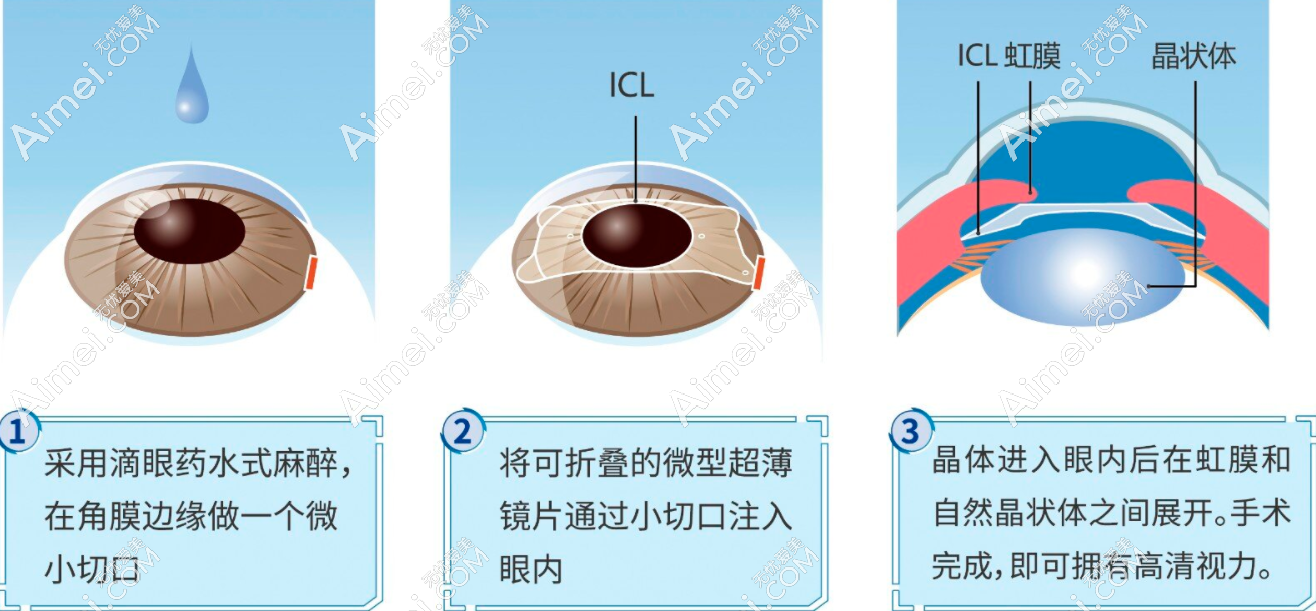 福州亮睛眼科胡建章医生做晶体植入近视好 福州亮睛眼科胡建章医生做晶体植入近视好