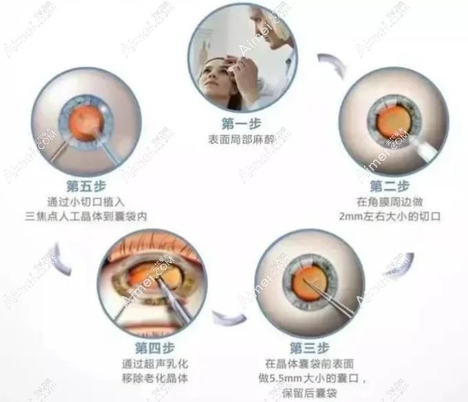 李志强医生做三焦点人工晶体好