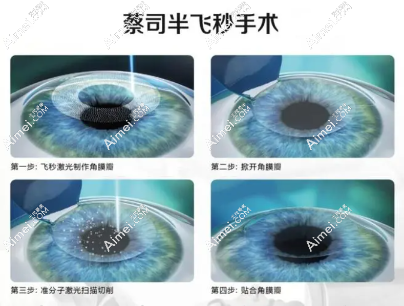 半飞秒激光近视眼手术过程和步骤