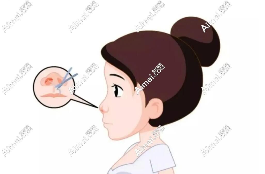 成都出名的隆鼻医生排名www.dlren.com 成都出名的隆鼻医生排名www.dlren.com