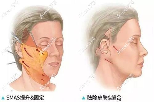 广州拉皮手术好的医生推荐(详见广州小切口拉皮好的医生排行).jpg 广州拉皮手术好的医生推荐(详见广州小切口拉皮好的医生排行).jpg