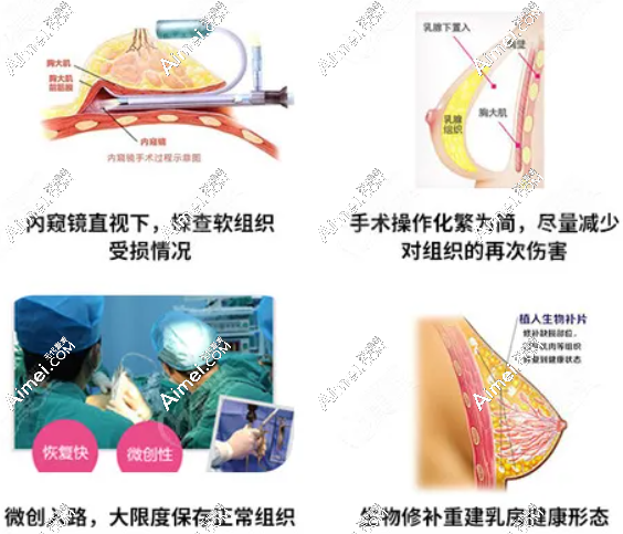 广州荔湾区人民医院隆胸修复技术好