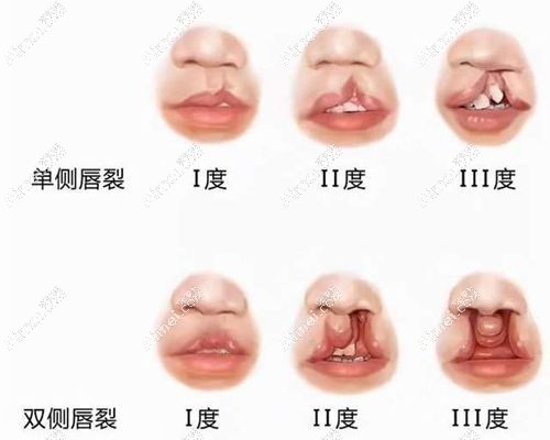余文林修复嘴唇价格多少钱