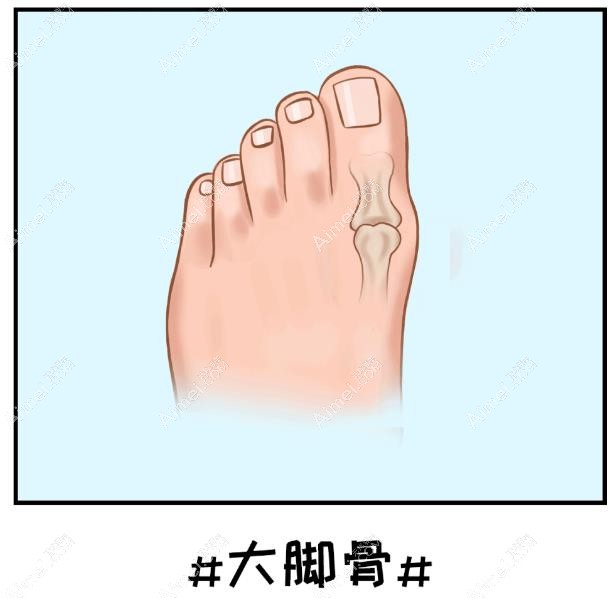 苏敬达医生拇外翻微创是什么术式做的?答:微孔技术,恢复的快/痛感轻