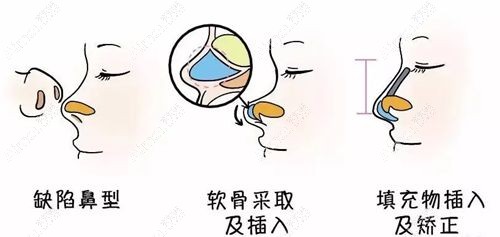 李劲良隆鼻收费不贵 李劲良隆鼻收费不贵
