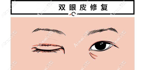 我找过史迎军修复双眼皮真人实例 我找过史迎军修复双眼皮真人实例