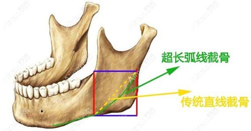 赵延峰下颌角保守,磨骨不狠 赵延峰下颌角保守,磨骨不狠