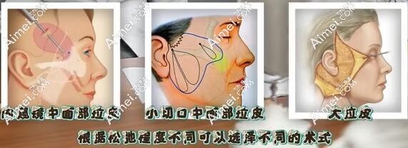 谢宏彬做拉皮手术做的好 谢宏彬做拉皮手术做的好