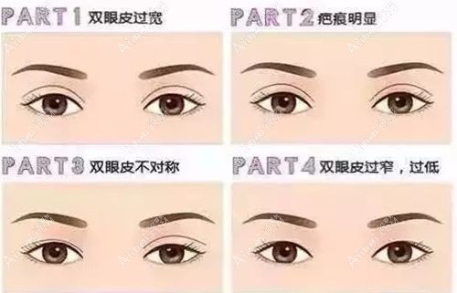 刘志刚修复双眼皮类型全 刘志刚修复双眼皮类型全
