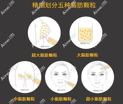 冯斌脂雕移植高清图片 冯斌脂雕移植高清图片
