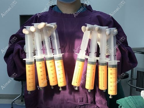 冯斌自体脂肪丰胸价格多少 冯斌自体脂肪丰胸价格多少