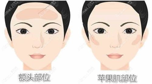 北京纯脂王自谦做全脸脂肪填充的手术过程
