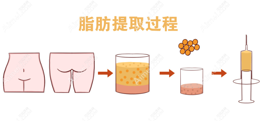 余恩旭脂肪填充怎么样 余恩旭脂肪填充怎么样