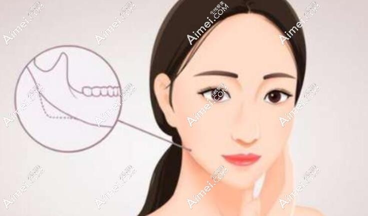长线条下颌角磨骨 长线条下颌角磨骨