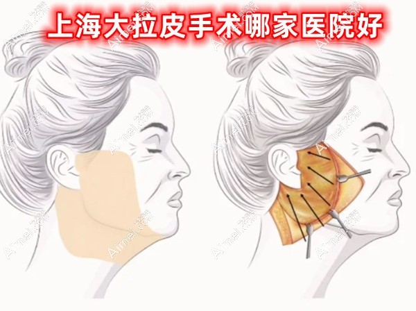 上海大拉皮手术哪家医院好?拉皮有名医生坐诊医院前10一览